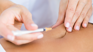 Liposuzione laser a Roma